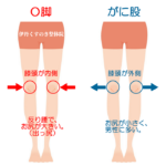 ガニ股О脚